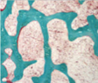 An image of normal bone showing mineralized bone in green, and unmineralized osteoid in orange or red. 