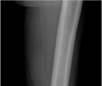 An X-ray of a normal femur.