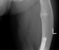 An X-ray of a femur with a pseudofracture.