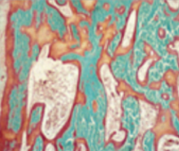 An image of bone showing mineralized bone in green, and prominent unmineralized osteoid in orange or red. 