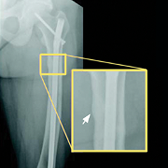 An X-ray image of a bone with a pseudofracture after 24 weeks of CRYSVITA, with a zoomed-in image of the healed fracture.