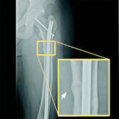 An X-ray image of a bone with a pseudofracture, with a zoomed-in image of the fracture.