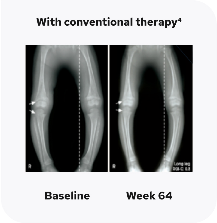 X-ray images of a pair of legs with skeletal abnormalities. The first image is at baseline, and the second image is after 64 weeks on conventional therapy