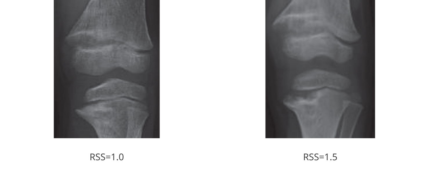 An X-ray image of a knee, captioned “RSS=1.0” and “RSS=1.5”
